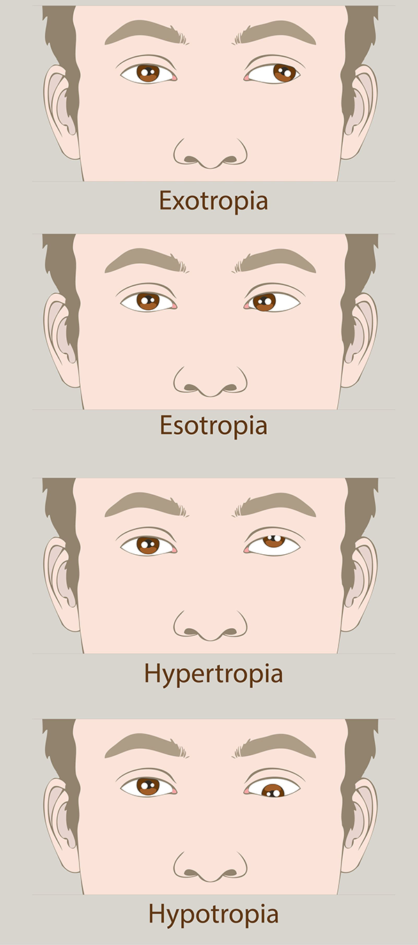 Causes Amblyopia in Monmouth County