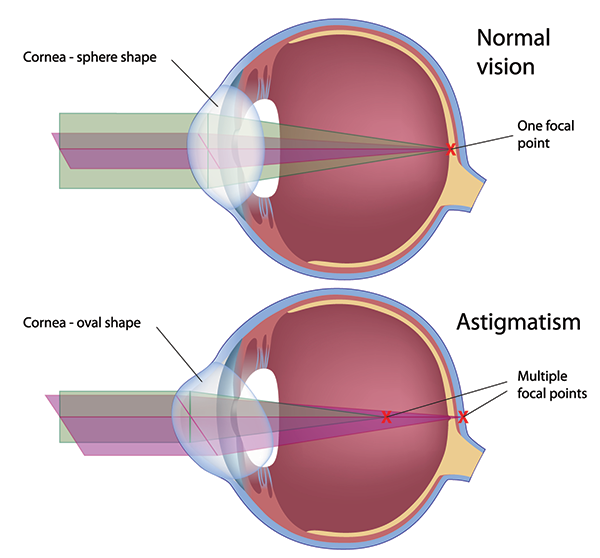 Monmouth County Astigmatism