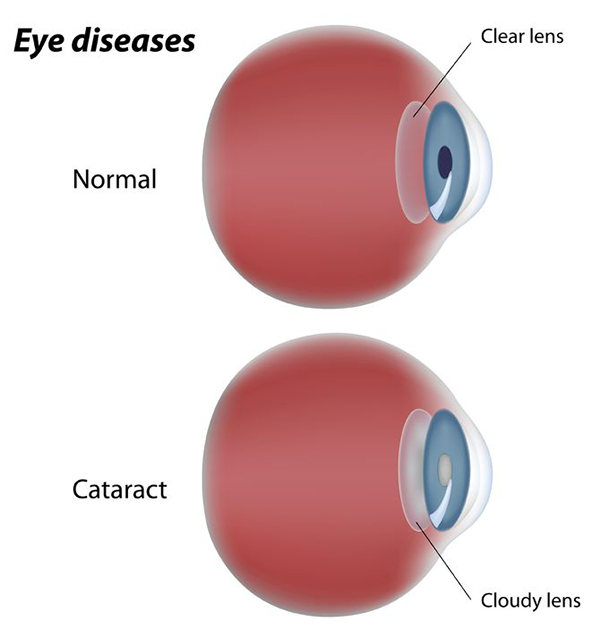 Monmouth County Cataracts