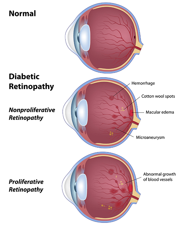 Diabetic Retinopathy in Monmouth County