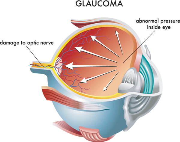 Glaucoma