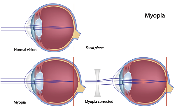 Myopia in Monmouth County
