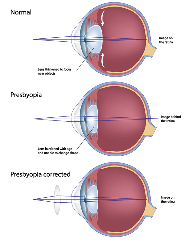 Presbyopia in Monmouth County