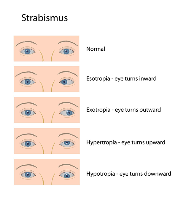Strabismus in Monmouth County