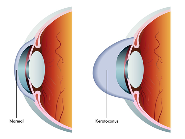 Monmouth County Causes Keratoconus